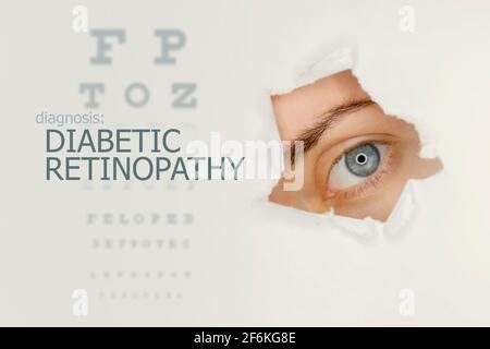 Woman`s eye looking trough teared hole in paper, eye test with words Diabetic Retinopathy on right. Eye disease concept template. Grey background. Stock Photo